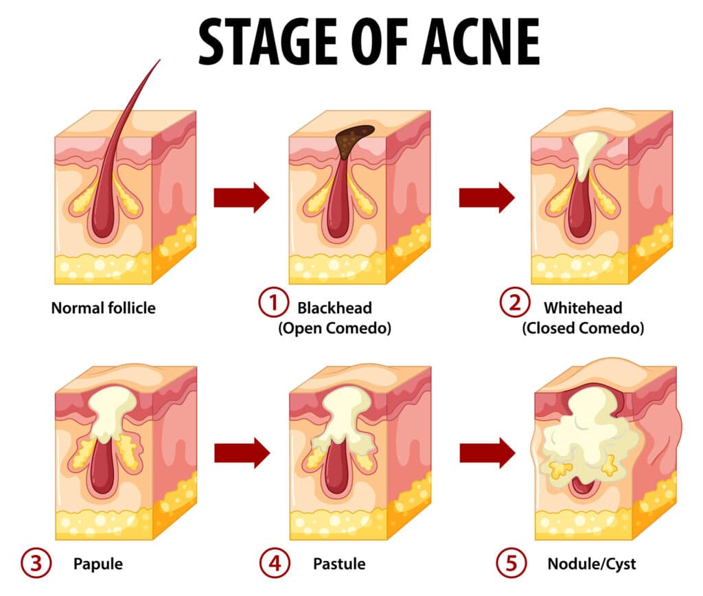 illustration of the stages of acne