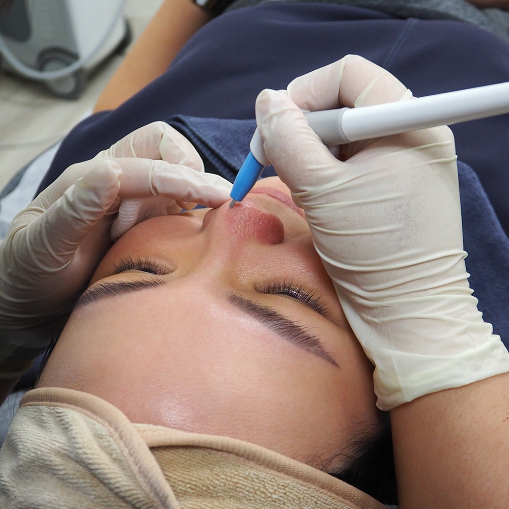 Doctor of Ozhean Zoey Singapore performing agnes treatment to remove acne permanently