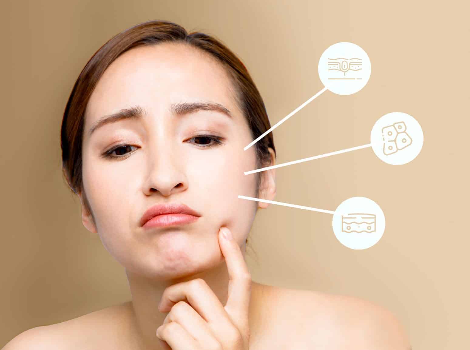Female having issues with different types of acne