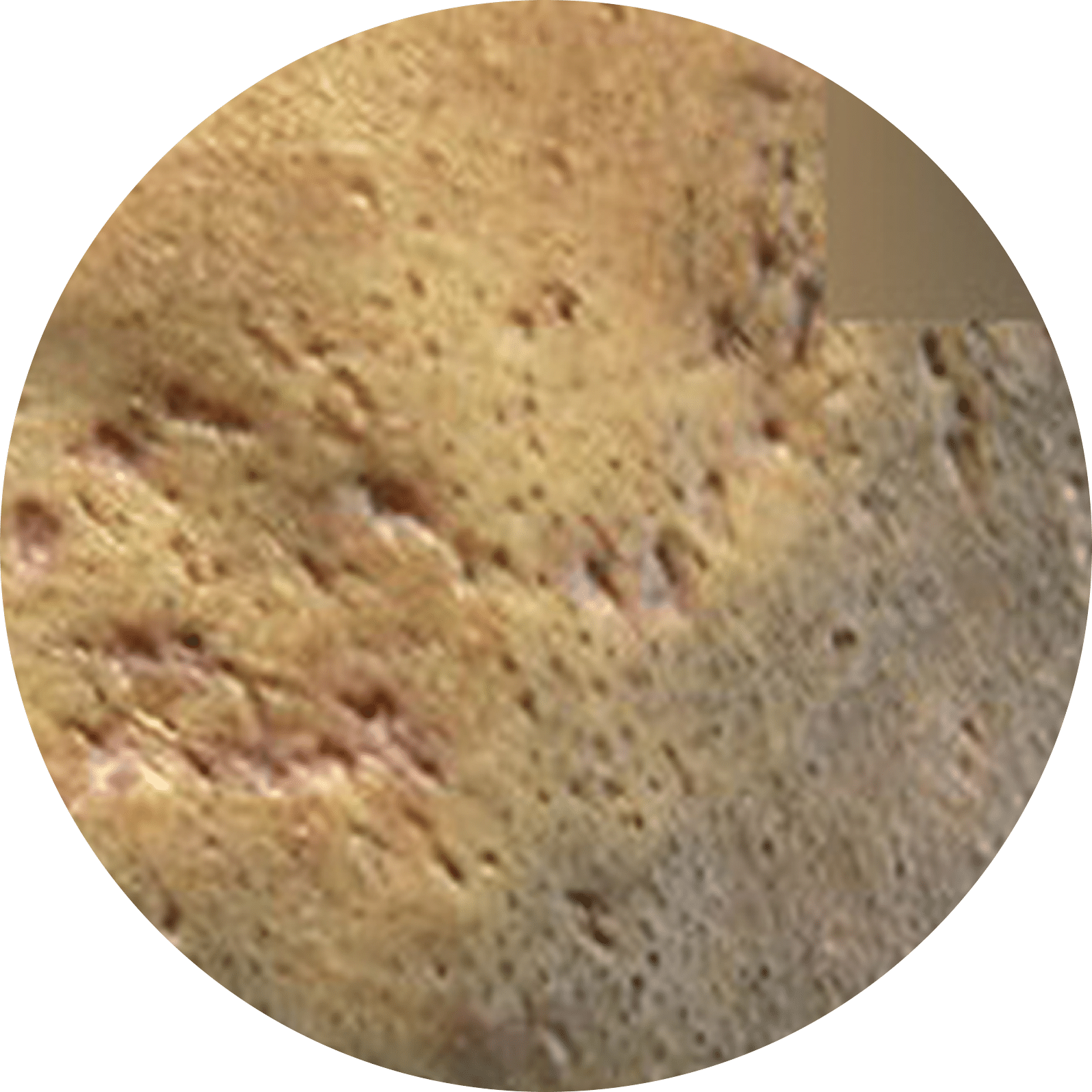 acne scar