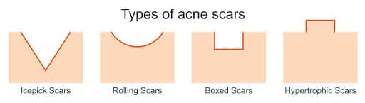 Types of Acne Scars