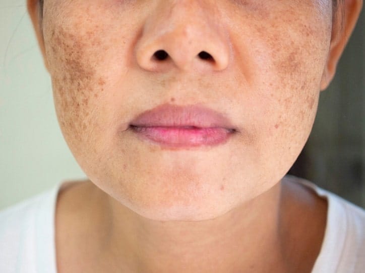Lady suffering from Melasmaa