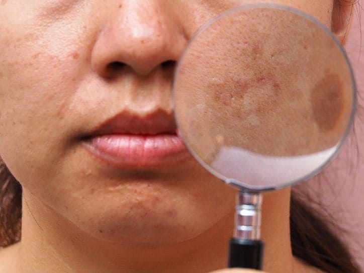 Lady suffering from melasma 2